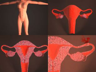 子宫模型,精卵结合,宫外孕医学动画