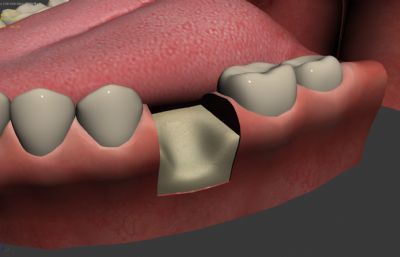 牙齿放入骨丝手术动画,补牙手术3D模型