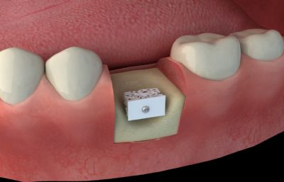 牙齿放入骨丝手术动画,补牙手术3D模型