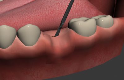 补牙手术,牙齿放入螺丝手术3D动画模型