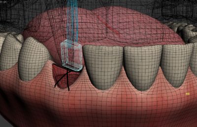 牙齿放入骨块缝合手术3D模型动画源文件