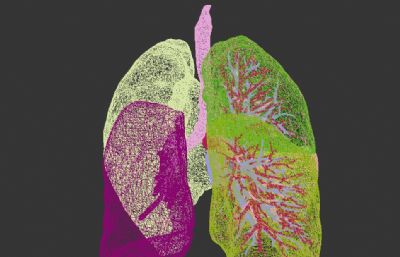 人体肺部+动脉+静脉+肺部血管+病变肿瘤。